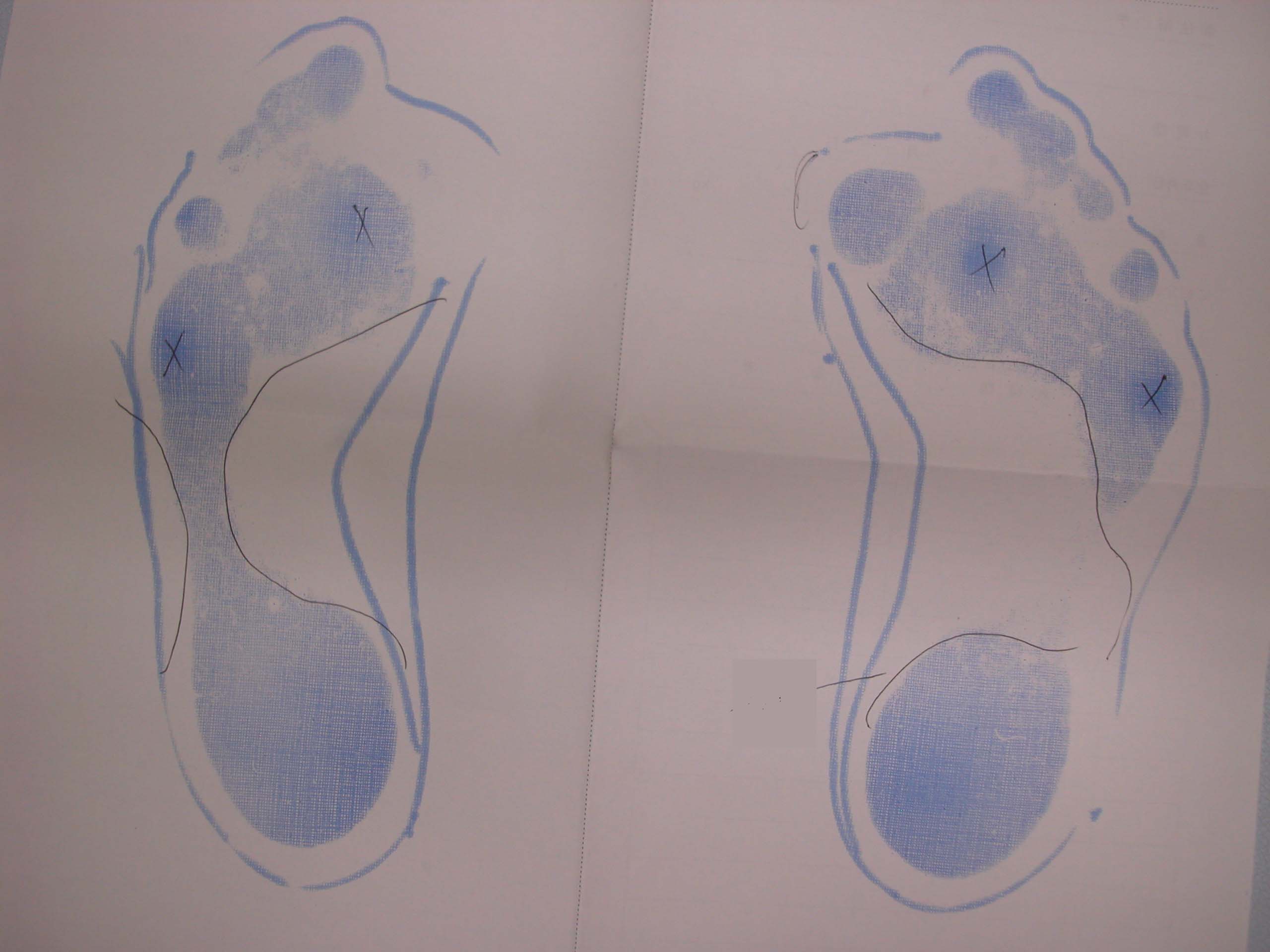 アペール症候群の足のフット・プリント