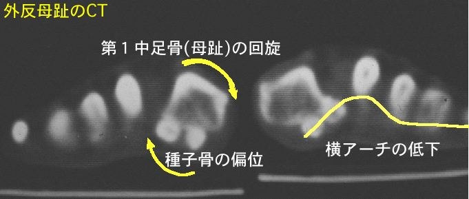 正常前足部CT