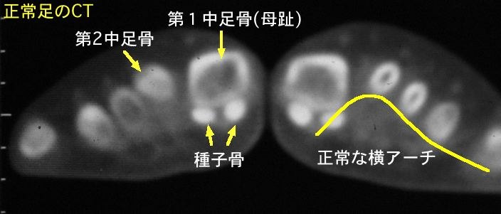 正常前足部CT