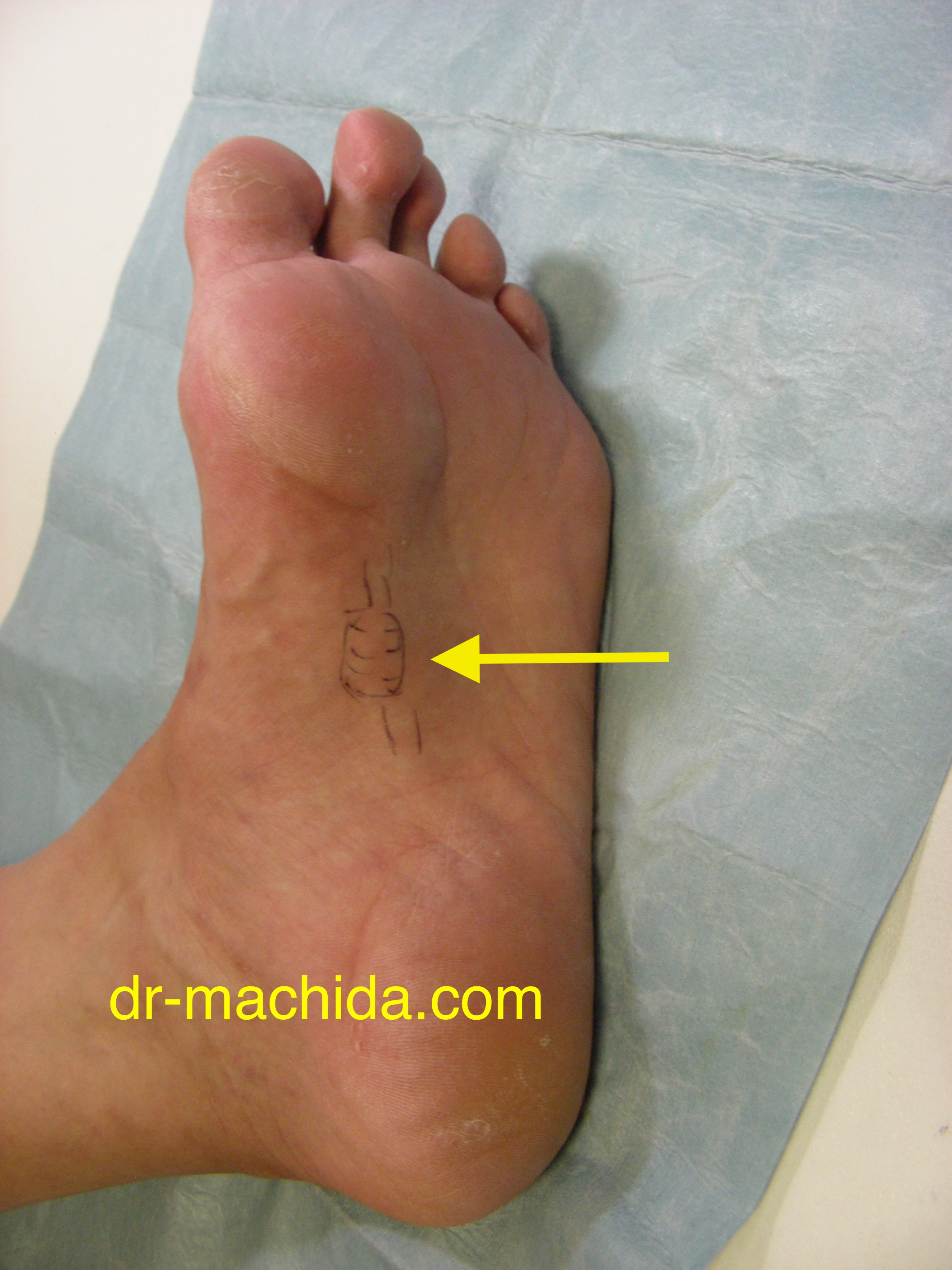 Ledderhose’s  disease_photo_fibroma_47f_web.jpg