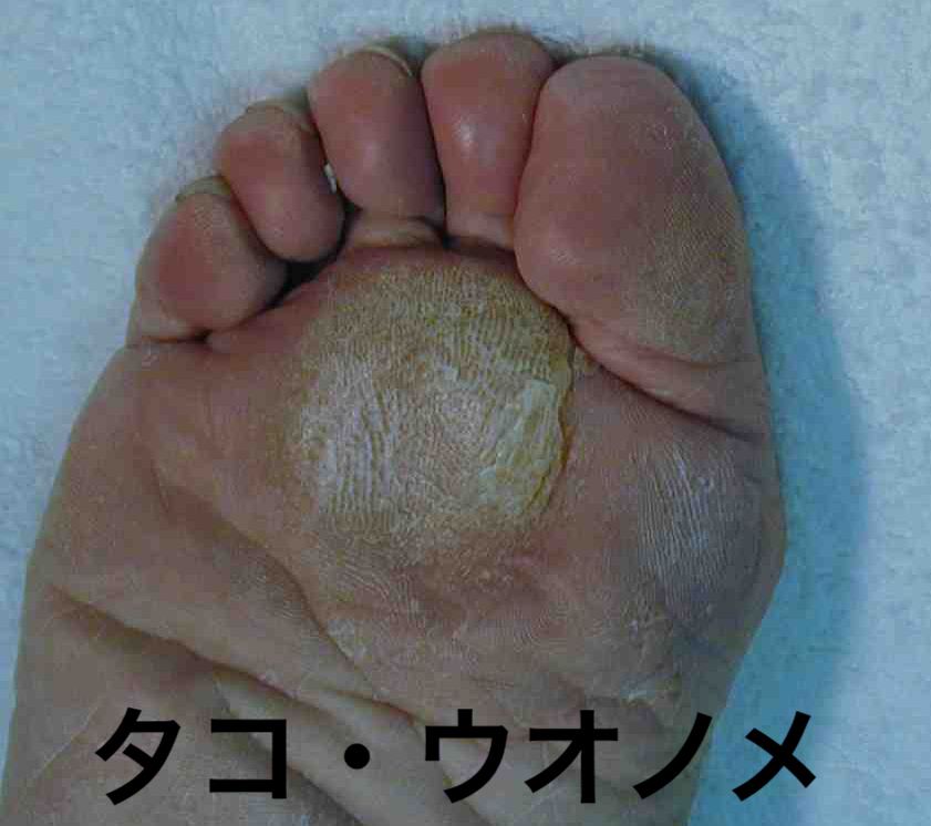 胼胝_写真