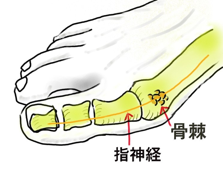 指神経絞扼