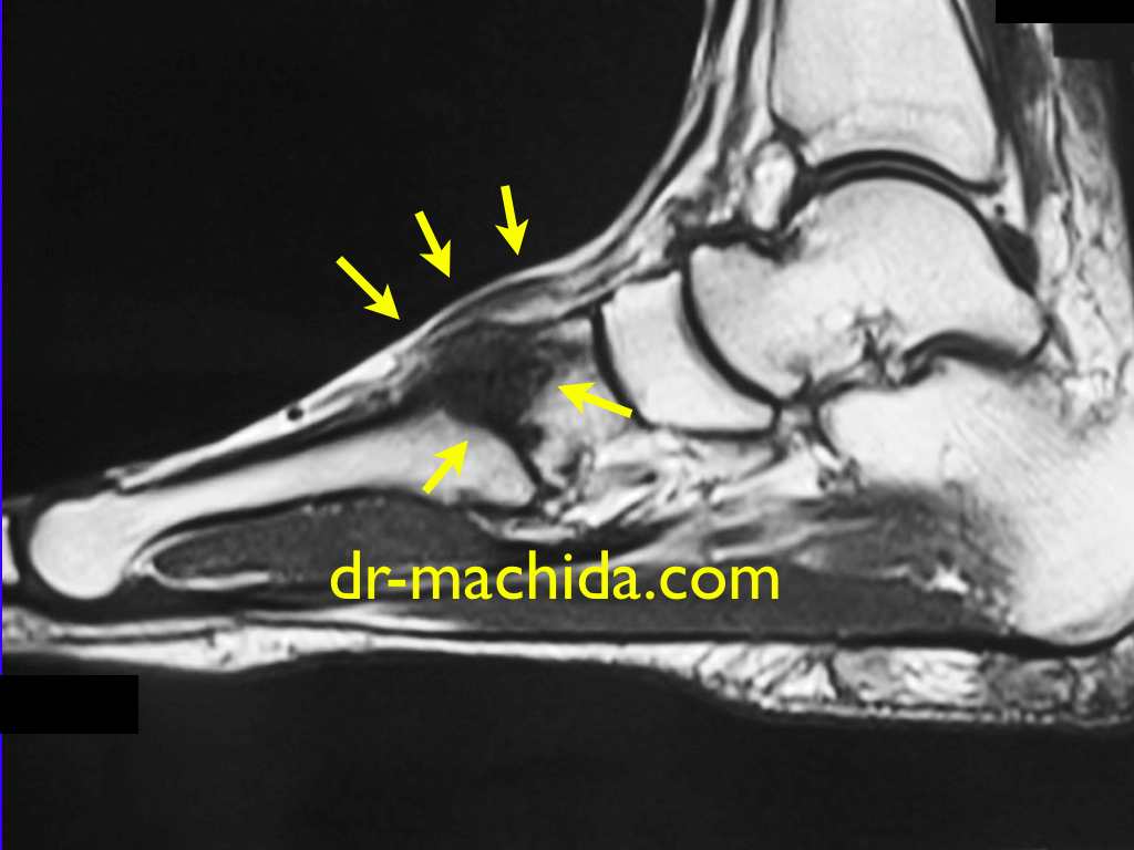 MRI_Lisfranc_joint.jpg