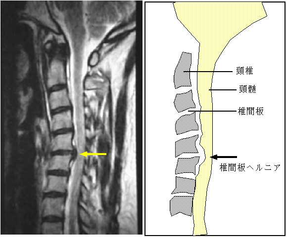 頸椎椎間板ヘルニアのMRIと図