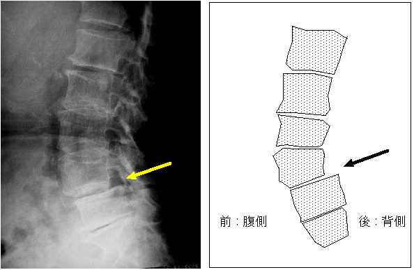 すべり症のX線と図