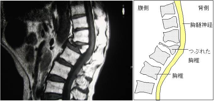 胸椎変形のMRIと図